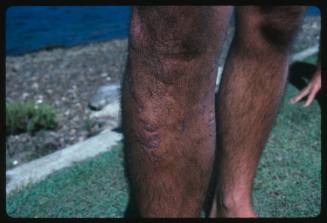 A close up view of the shin on a person that has scars from a shark attack