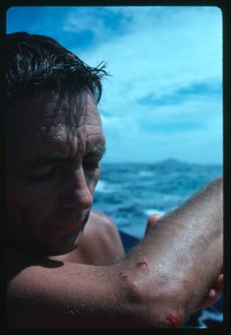 Ron Taylor holding up his arm which has fresh wounds from a shark attack