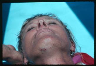 A close view of a Great Reef Shark bite on the bottom of Valerie Taylor’s chin