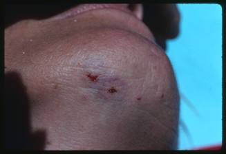 A close detailed view of a Great Reef Shark bite on the bottom of Valerie Taylor’s chin