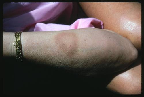 Close up view of bruising on a person’s forearm