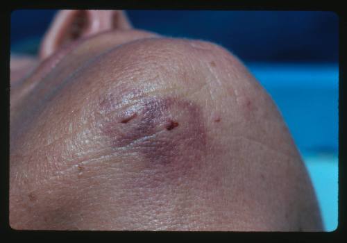 A close up of the bottom of Valerie Taylor’s chin showing a wound from a bite by a Grey Reef shark