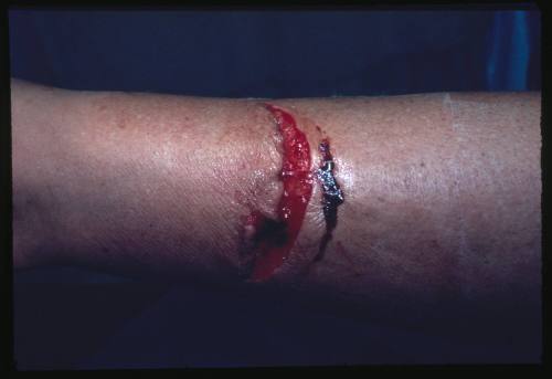 A close up of fresh wounds from a shark bite on a person’s forearm