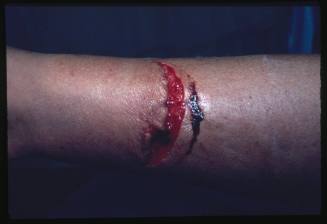 A close up of fresh wounds from a shark bite on a person’s forearm