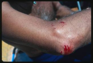 A close view of Ron Taylor’s elbow after it had been bitten by a Wobbegong shark