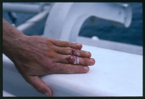 Wounds from a shark bite on the fingers of a hand