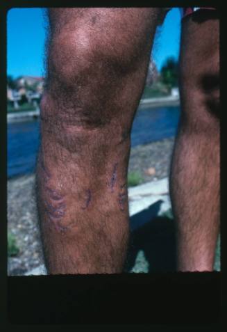 A close up view of the shin of a person that has scars from a shark attack