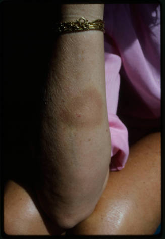 Close up view of bruising on a person’s forearm