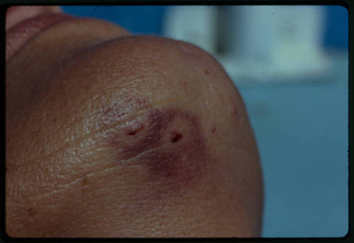 A close up of the bottom of Valerie Taylor’s chin showing a wound from a bite by a Grey Reef shark