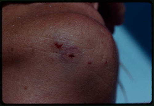 A close up of the bottom of Valerie Taylor’s chin showing a wound from a bite by a Grey Reef shark