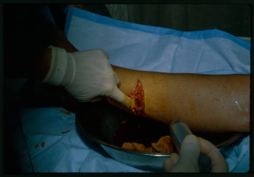 Close up shot of a doctor inspecting an open wound on Valerie Taylor's lower calf