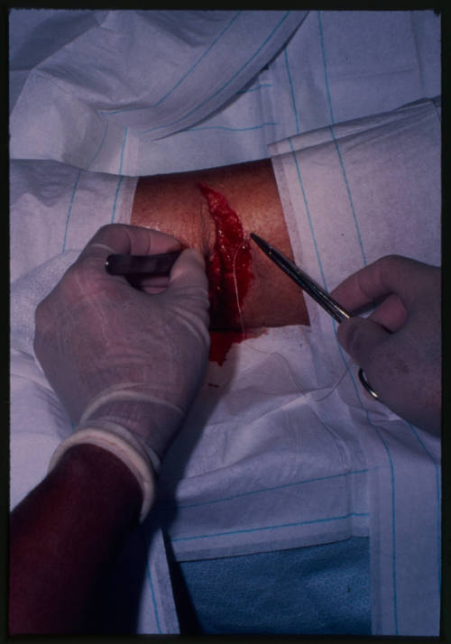 Close up shot of doctor finishing stitching wound on Valerie Taylor's calf, holding forceps and tweezers