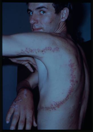 Side view shot of Rodney Fox' face, torso and left hand showing large scars from Great Whiite Shark bite injury