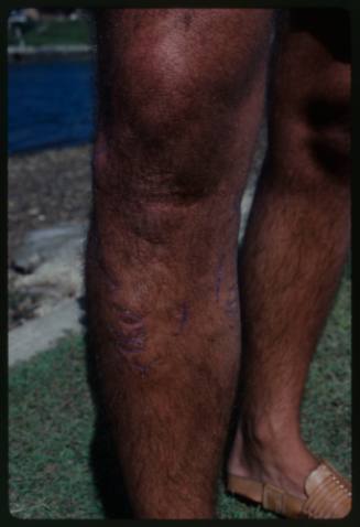 Ron Taylor's left leg with shark bite scarring on upper shin