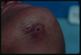 Shot of Valerie Taylor's lower chin with puncture marks and bruising from shark bite