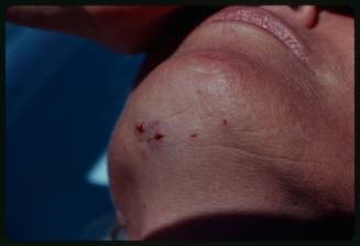 Shot of Valerie Taylor's lower chin with puncture marks and bruising from shark bite
